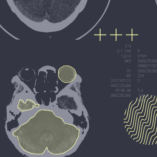 CT scan